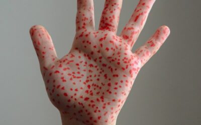 Measles Case Confirmed at Florida High School — Vaccinated Students Well Protected