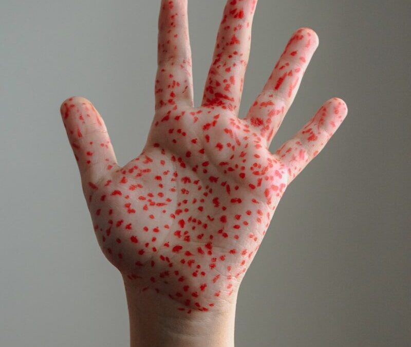 Measles Case Confirmed at Florida High School — Vaccinated Students Well Protected